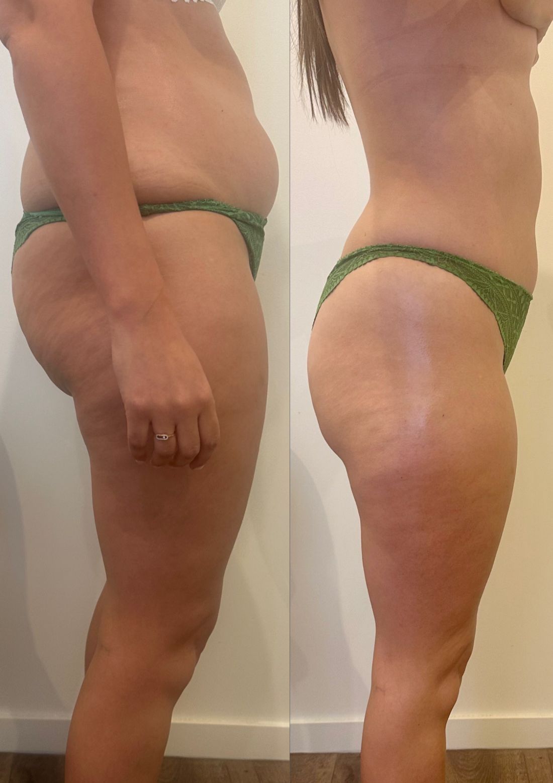 Deux photos de profil d'une même cliente en sous-vêtement, avant et après une séance de drainage lymphatique brésilien au centre Haïko